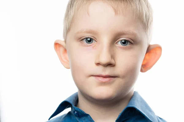 Child eye herpes disease on a face. — Stok fotoğraf
