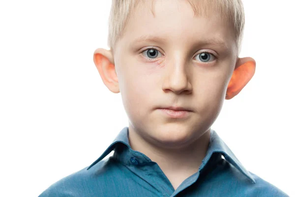 Herpes ocular en la cara de un niño . —  Fotos de Stock