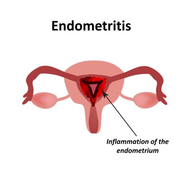 Endometritis. Endometrium enflamasyonu. Rahim iltihabı. Infographics vektör illüstrasyon izole arka plan üzerinde