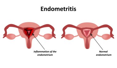 Endometritis. Endometrium enflamasyonu. Rahim iltihabı. Infographics vektör illüstrasyon izole arka plan üzerinde