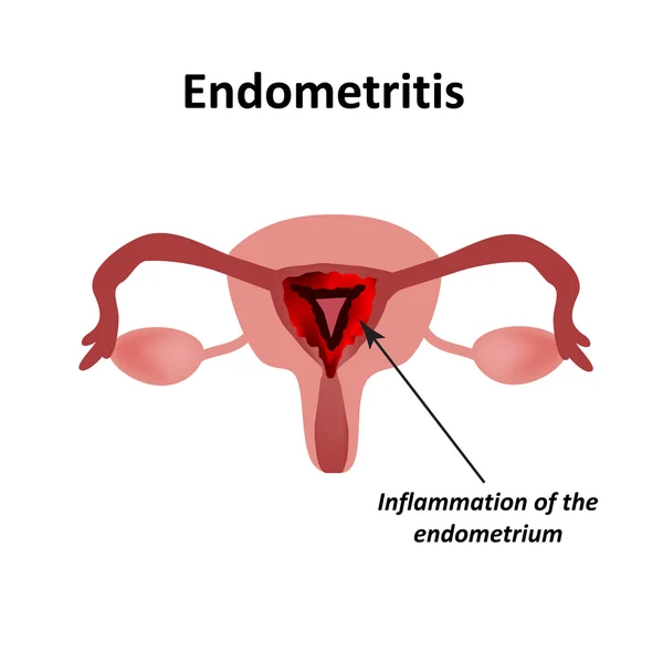 Endometrite. Inflamação do endométrio. Inflamação do útero. Infográficos Ilustração vetorial em fundo isolado — Vetor de Stock