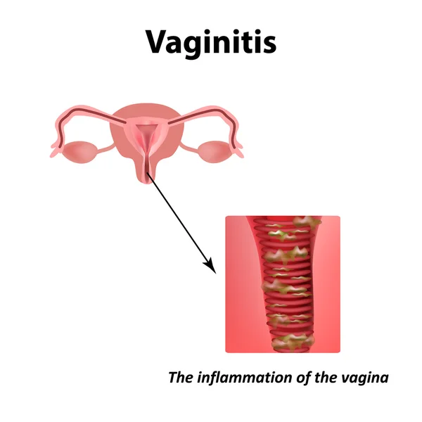 Inflamación de la vagina. Vaginitis. Infografías. Ilustración vectorial sobre fondo aislado — Vector de stock