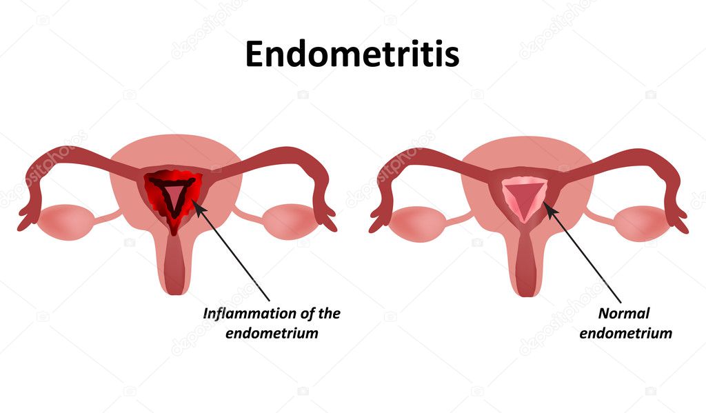 Endometritis. Inflammation of the endometrium. Inflammation of the uterus. Infographics Vector illustration on isolated background