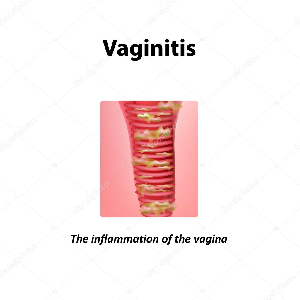 Inflammation of the vagina. Vaginitis. Infographics. Vector illustration on isolated background