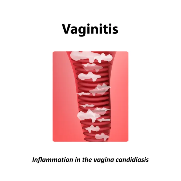 Vaginitis. Inflamación en la candidiasis vaginal aftas. Infografías. Ilustración vectorial sobre fondo aislado — Vector de stock