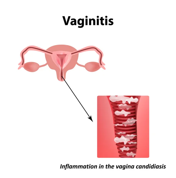 Vaginitis. Inflamación en la candidiasis vaginal aftas. La estructura de los órganos pélvicos. Infografías. Ilustración vectorial sobre fondo aislado — Vector de stock