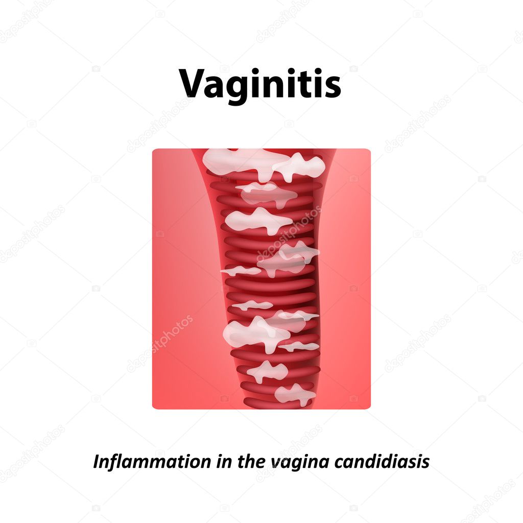 Vaginitis. Inflammation in the vagina candidiasis thrush. Infographics. Vector illustration on isolated background