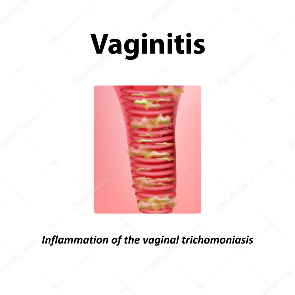 Trichomoniasis: belirtiler, sonuçları, tanı, tedavi Trichomoniasis: belirtiler, sonuçları, tanı, tedavi