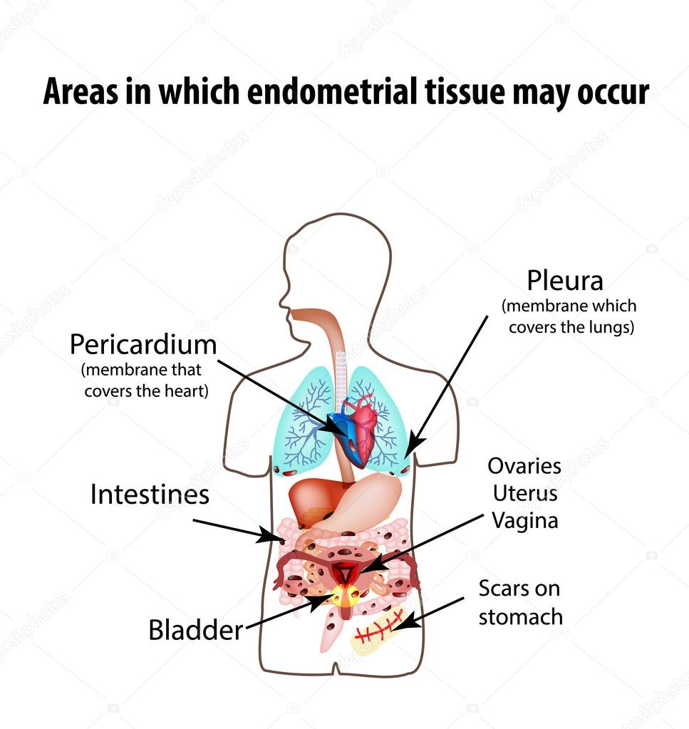 Areas in which endometrial tissue can appear. Endometriosis. Endometriosis in the body. The structure of the lungs, heart, intestine, stomach, liver, pelvic organs. Silhouette. Infographics Vector