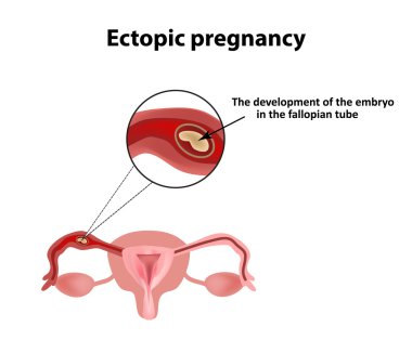 Dış gebelik. Embriyo fallop tüpü içinde. Infographics. Vektör illüstrasyon izole arka plan üzerinde