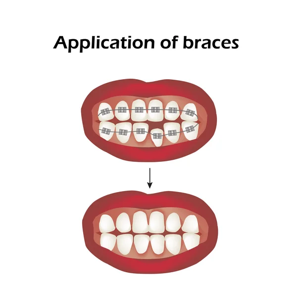 The use of braces. Crooked teeth. Orthodontics. Infographics. Vector illustration on isolated background — Stock Vector