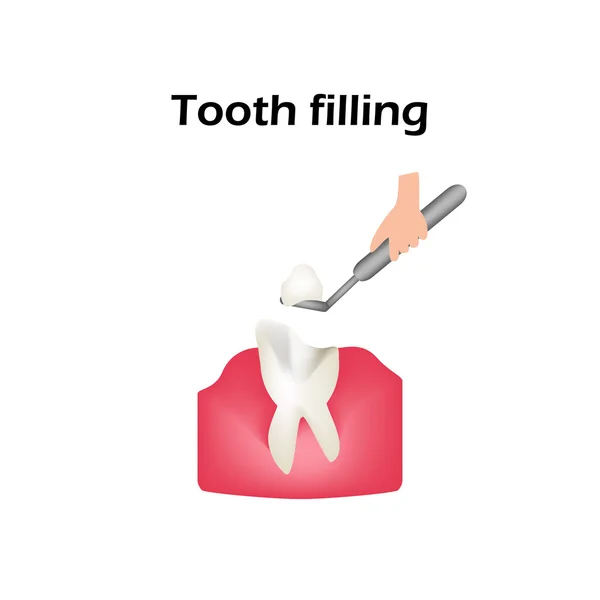 Treatment of caries. Sealing of the tooth. Infographics. Vector illustration on isolated background — ストックベクタ