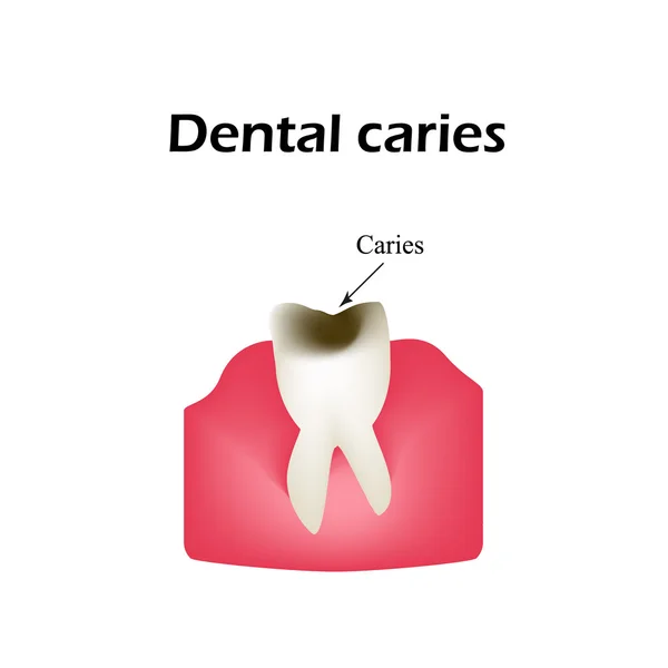 Decadência dentária profunda. Ilustração vetorial sobre fundo isolado — Vetor de Stock