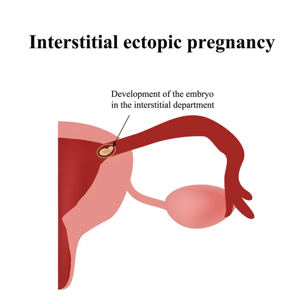 A megyében az interstitialis embrió fejlesztése. Méhen kívüli terhesség. Infographics. Elszigetelt háttér vektor illusztráció — Stock Fotó