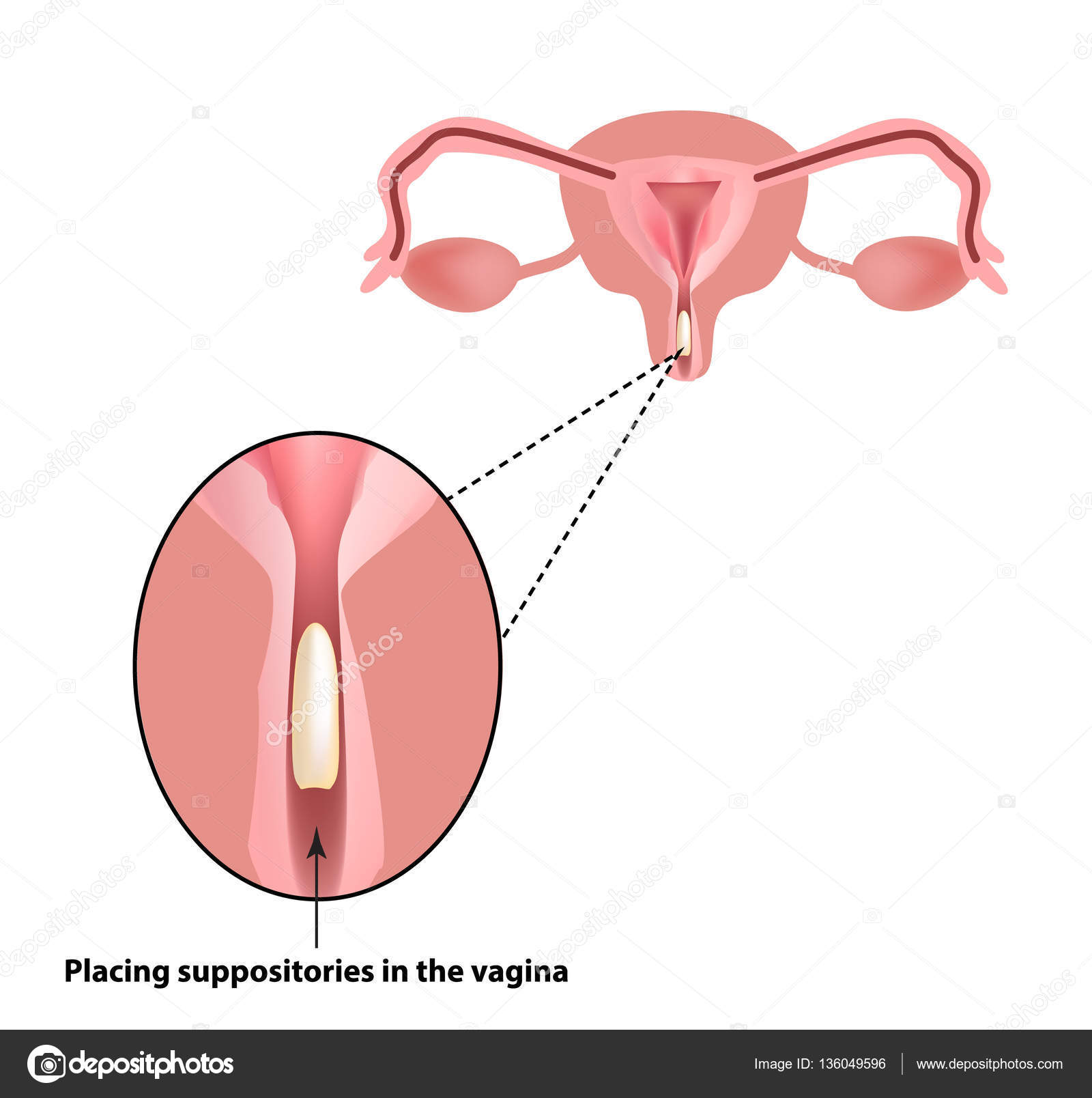 Tratamento de supositórios de vaginite. inflamação da vagina. Infográficos.  ilustração vetorial em fundo isolado imagem vetorial de mikrostoker©  136049596