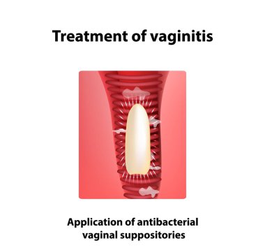 Treatment of vaginitis suppositories. inflammation  the vagina. Infographics. vector illustration on isolated background clipart