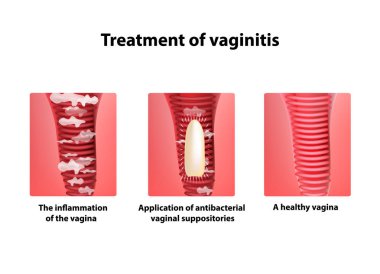 Treatment of vaginitis suppositories. inflammation  the vagina. Infographics. vector illustration on isolated background clipart