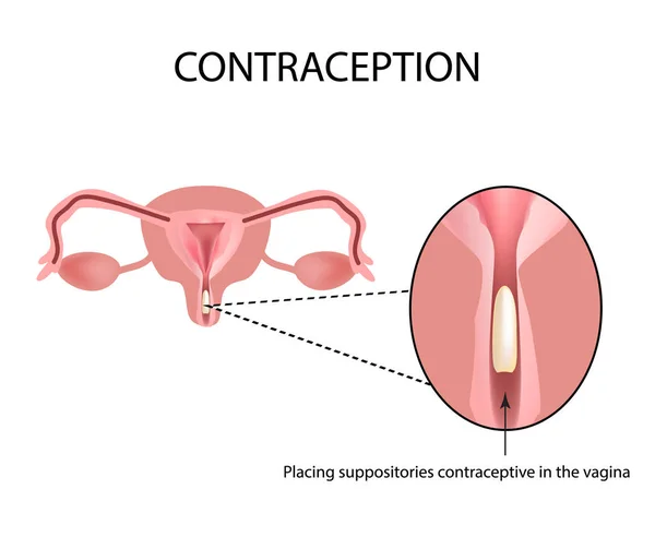 Preventivmedel stolpiller. Infographics. Vektorillustration på isolerade bakgrund — Stock vektor