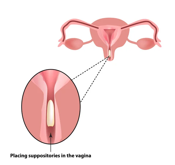 Tratamiento de supositorios de vaginitis. inflamación la vagina. Infografías. ilustración vectorial sobre fondo aislado — Vector de stock