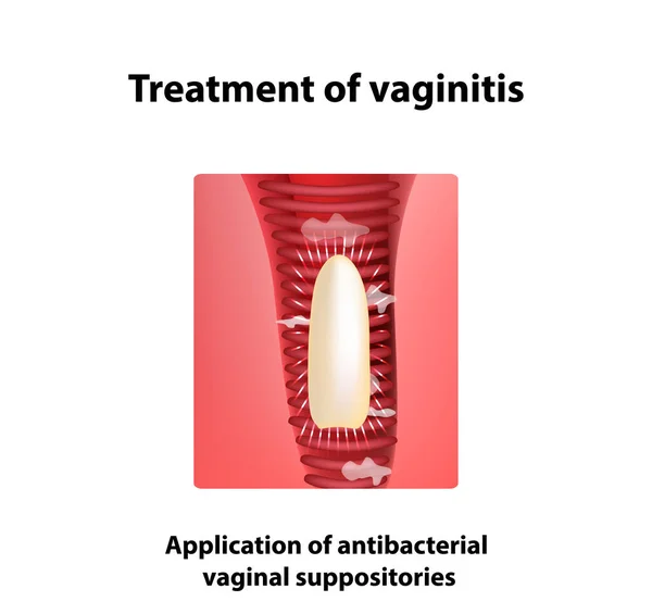 Tratamiento de supositorios de vaginitis. inflamación la vagina. Infografías. ilustración vectorial sobre fondo aislado — Vector de stock