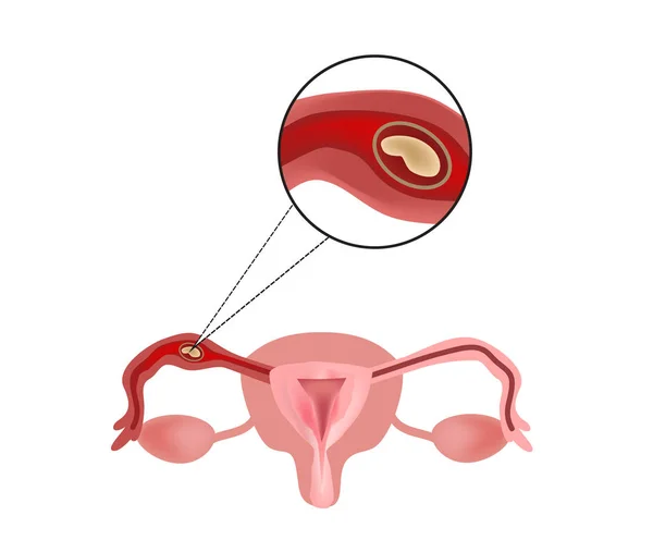 Gravidanza ectopica. L'embrione nella tuba di Falloppio. Infografica. Illustrazione vettoriale su sfondo isolato — Vettoriale Stock