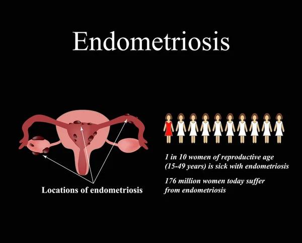 Endometriosis. Endometrium ciszták. A méhnyálkahártya. Statisztika. A kismedencei szervek szerkezete. Infographics vektoros illusztráció — Stock Vector