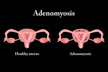 Endometriosis. The structure of the pelvic organs. Adenomyosis. The endometrium. Vector illustration clipart