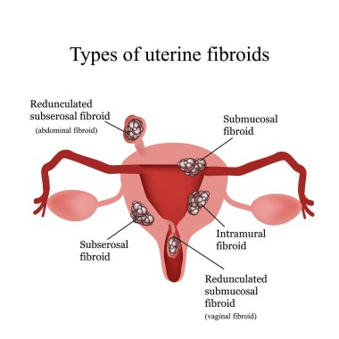 Uterin fibroids türleri. Endometriozis. Infographics. Beyaz arka plan üzerinde izole vektör çizim