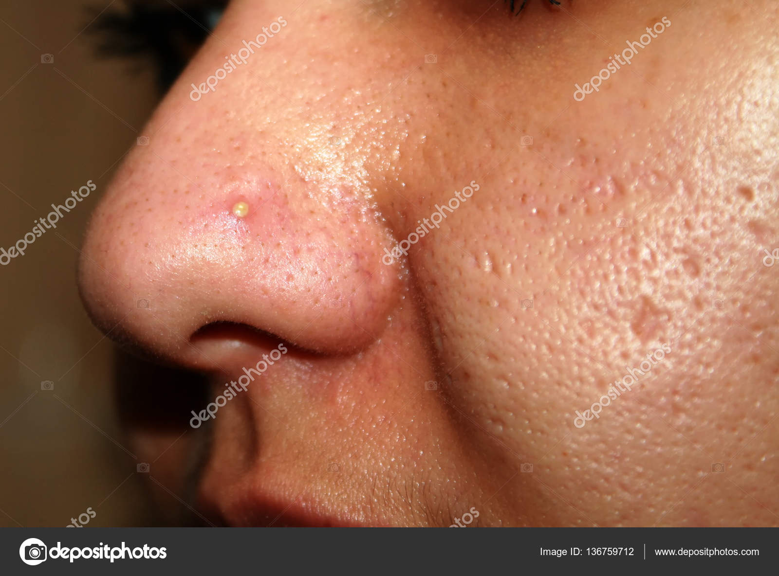 acne neus acne neus