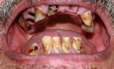 Çürük dişler kötü. Sakal ve bıyık. Çürük. Periodontal hastalık. Diş tartar.