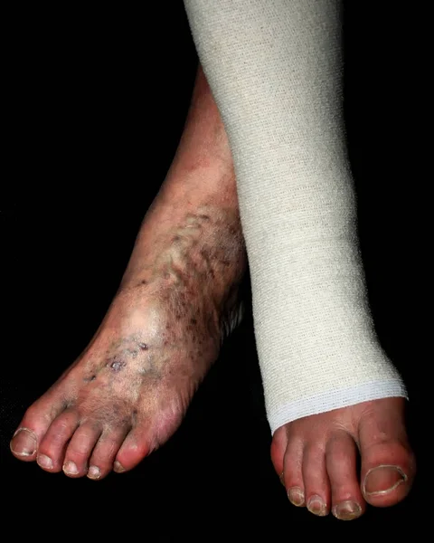 Pierna. Varices, venas. Phlebeurysm. Tromboflebitis. Venda elástica . — Foto de Stock