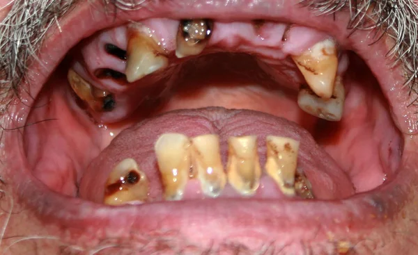 Dents pourries. Barbe et moustache. Des caries. Maladie parodontale. Tartre dentaire . — Photo