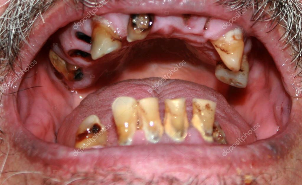 Fotos: dientes podridos | Dientes mal podridos. Barba y bigote. Caries