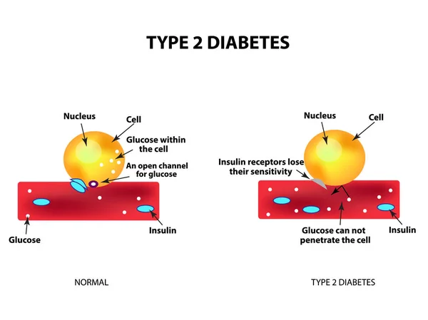 La absorción de glucosa por la célula. Diabetes tipo 2. Aumentar y disminuir el azúcar en sangre. Insulina. Infografías. Ilustración vectorial sobre fondo aislado — Vector de stock