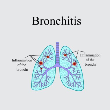 Bronşit. İnsan akciğer anatomik yapısı. Gri bir arka plan üzerinde vektör çizim