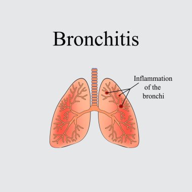 Bronşit. İnsan akciğer anatomik yapısı. Gri bir arka plan üzerinde vektör çizim