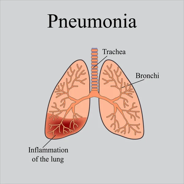 Pneumonia. A estrutura anatômica do pulmão humano. Ilustração vetorial sobre fundo cinzento —  Vetores de Stock