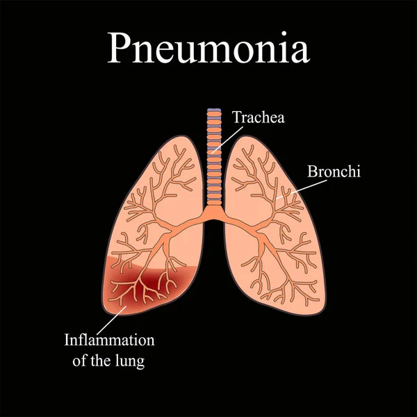 Pneumonia. A estrutura anatômica do pulmão humano. Ilustração vetorial sobre fundo preto — Vetor de Stock