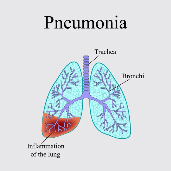 肺炎。人間の肺の解剖学的構造。灰色の背景のベクトル図 — ストックベクタ