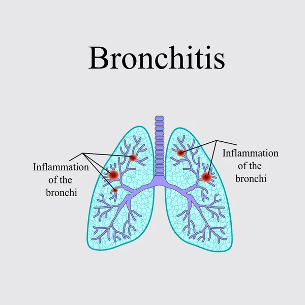 Bronquitis. La estructura anatómica del pulmón humano. Ilustración vectorial sobre fondo gris — Archivo Imágenes Vectoriales