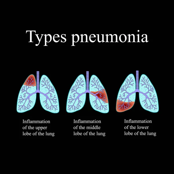 Pneumonia. A estrutura anatômica do pulmão humano. Tipo de pneumonia. Ilustração vetorial sobre fundo preto — Vetor de Stock