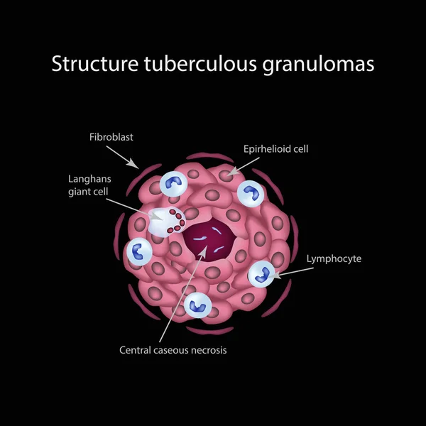 Estructura de los granulomas tuberculosos. Ilustración vectorial — Archivo Imágenes Vectoriales