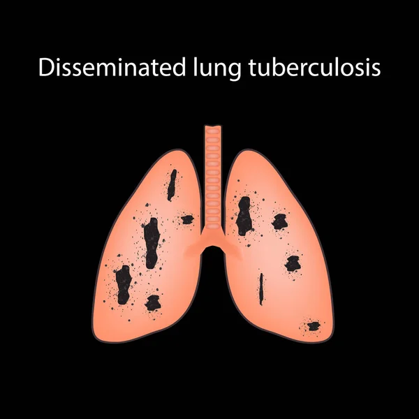 Disseminerad tuberkulos. Vektorillustration på svart bakgrund — Stock vektor