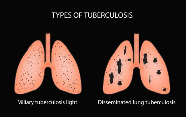 Tipos de tuberculosis. Tuberculosis pulmonar miliar y diseminada. Ilustración vectorial sobre fondo negro — Vector de stock