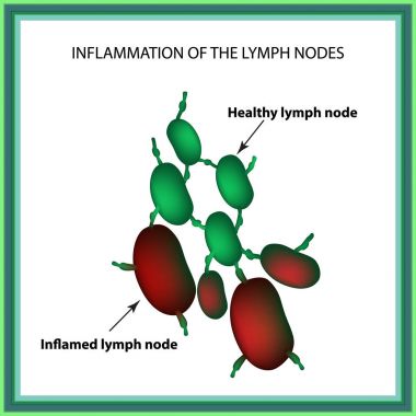Inflammation of the lymph nodes. Infographics. Vector illustration on isolated background clipart