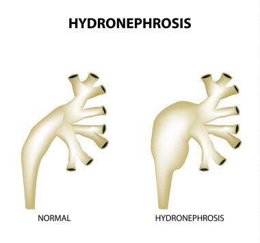 Hydronephrosis. Leğen kemiği. Böbrek. Infographics. Vektör illüstrasyon izole arka plan üzerinde