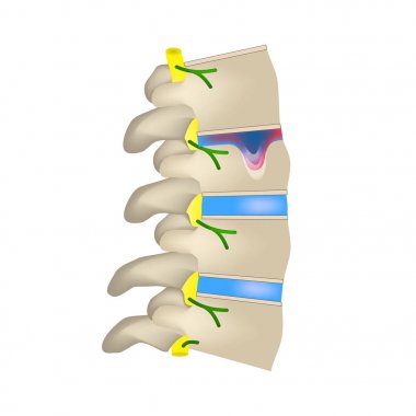 Fıtık Schmorl. İntervertebral disk. Yan görünümü. Omurga. Infographics vektör illüstrasyon izole arka plan üzerinde