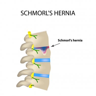 Fıtık Schmorl. İntervertebral disk. Yan görünümü. Omurga. Infographics vektör illüstrasyon izole arka plan üzerinde