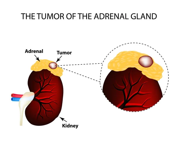 A tumor of the adrenal gland. Structure of the kidneys. Vector illustration on isolated background — Stock Vector