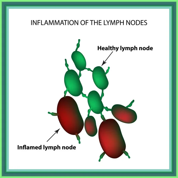 Inflamación de los ganglios linfáticos. Infografías. Ilustración vectorial sobre fondo aislado — Vector de stock